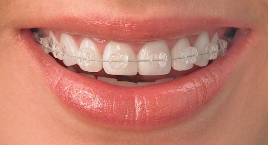 Aparelho Dentário: como funciona