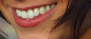 Como Branquear os Dentes